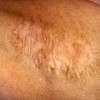 青岛哪里做腋臭手术