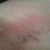 青岛治疗腋臭哪里好