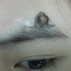 去掉色素痣好的诊疗方案_色素痣