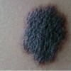 头顶切除色素痣_色素痣