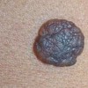 黑色素痣激光除掉_色素痣