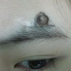 青岛色素痣的治疗处理原则_色素痣