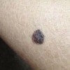 青岛色素痣的激光治疗_色素痣