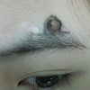 青岛色素痣最佳治疗的手法有什么_色素痣