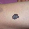 色素痣切除会复发吗_色素痣