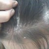 沧州患上银屑病的病因有什么