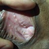 尖锐湿疣初期护理技巧