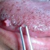 尖锐湿疣复发的八大因素