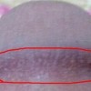 得了尖锐湿疣患者选择什么措施治疗能根除病毒