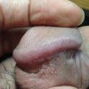 到底尖锐湿疣可以治愈吗