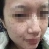 女性产后如何防范雀斑生长