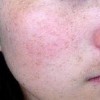 不做斑点女 预防雀斑从生活细节开始