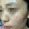 简单的介绍一下雀斑的诱发条件有哪些