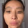 镭射纳米祛斑王 扫清三十个雀斑