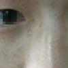 脸上有雀斑怎么办