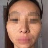 何谓雀斑皮肤