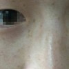 脸部雀斑是如何发生的呢