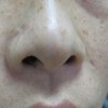 哪些年龄段雀斑会悄然而至