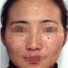 脸上雀斑能彻底去掉吗