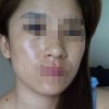 女性雀斑有碍瞻观怎么办呢