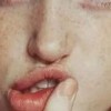 皮肤病雀斑去哪里看好