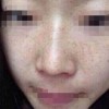 脸上雀斑怎么办呢
