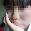 解析可爱的雀斑