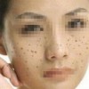 男性防止雀斑扩散注意什么事情