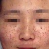什么是雀斑皮肤
