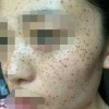女性朋友在哪个阶段容易长雀斑呢