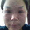 脸上雀斑怎么办