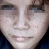 女性容易在哪个阶段患有雀斑呢