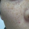 青岛脸部治疗雀斑的办法激光技术好吗
