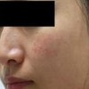 红血丝在临床上的症状