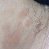 花斑癣的护理怎么进行