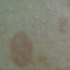 花斑癣初期病情