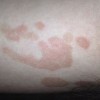 关于花斑癣的初期病情