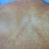 青岛关于花斑癣的治疗的手法