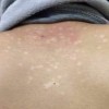 得了花斑癣怎么治呢