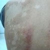 青岛花斑癣如何治疗