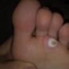 鸡眼的发病病因有什么
