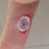 出现鸡眼该如何科学照护