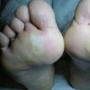 鸡眼的表现诊断