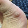 鸡眼的发病有什么特点