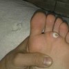 得了鸡眼我们要留意哪些