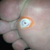 风油精治疗鸡眼有用吗
