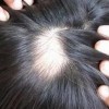 青岛女性植发治疗脱发以后怎样护理
