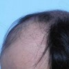 如何有效的预防脱发呢