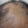 皮肤病专科医生解析：脱发的7个等级症状