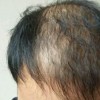 出现脱发该怎么办
